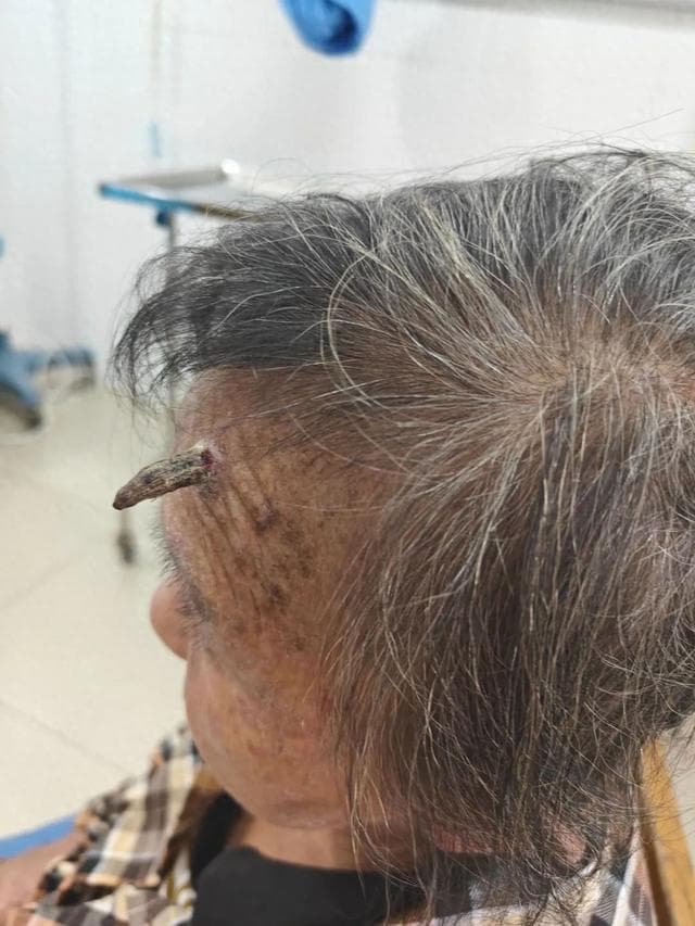 广西62岁阿姨头上长出“牛角”！医生：常见于这个群体，别忽视