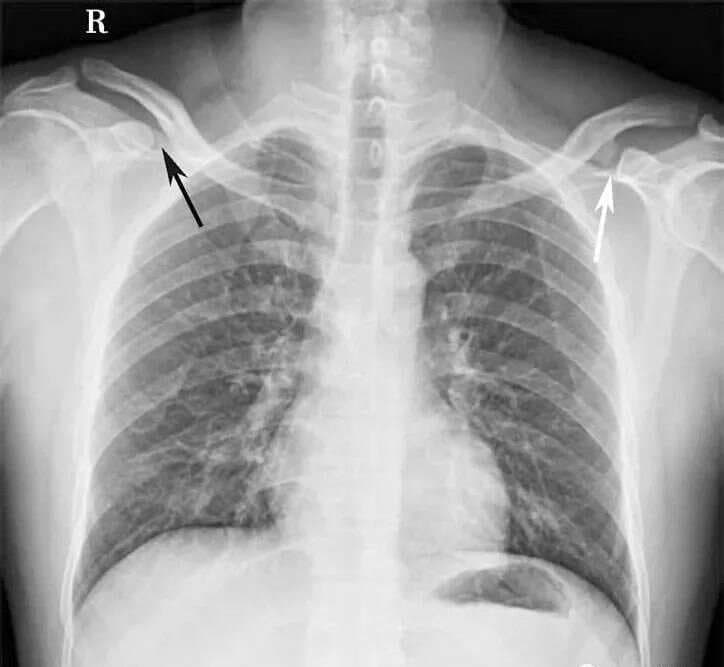 肩关节、肩锁关节及肩胛骨正常X线解剖、发育、常见病变图解