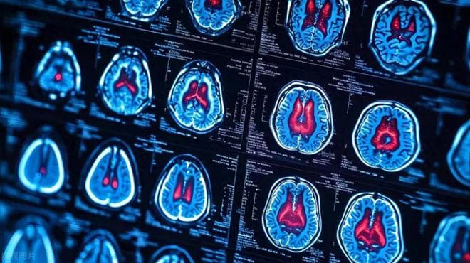 如何预防阿尔茨海默病：科学研究的最新总结