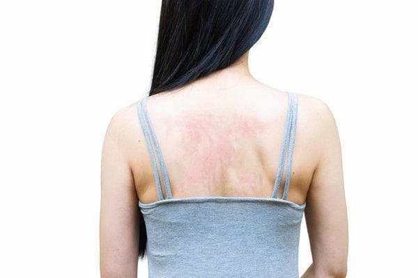 后背痒疼是什么原因女性