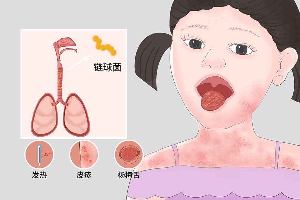 猩红热必须吃够10天头孢吗
