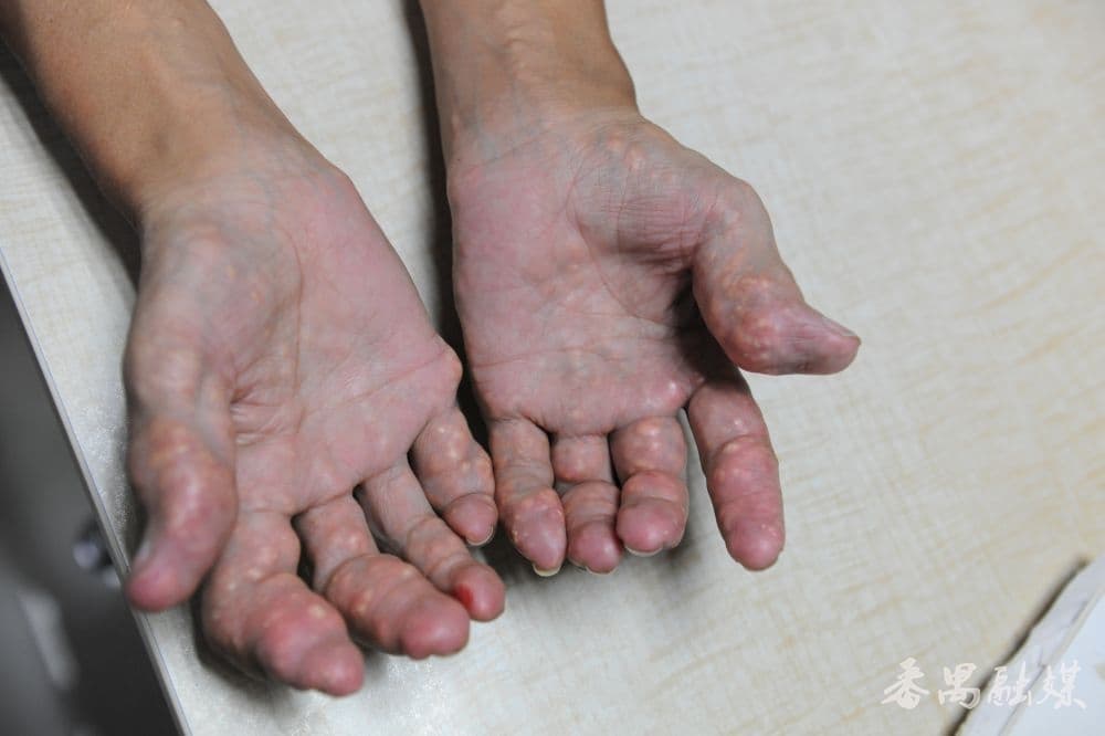 手肘上切下个“鹅蛋”  广医附属番禺中心医院使用创新方案，精准治疗痛风石
