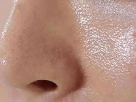 深度解析：皮肤出油原因及科学应对策略