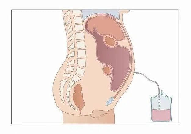 肿瘤患者，如何应对“腹水”?