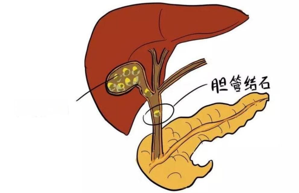 取“石”有道！治疗胆管疾病，胆道镜是个神器