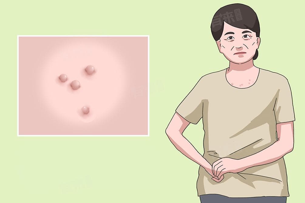 皮赘发生的原因