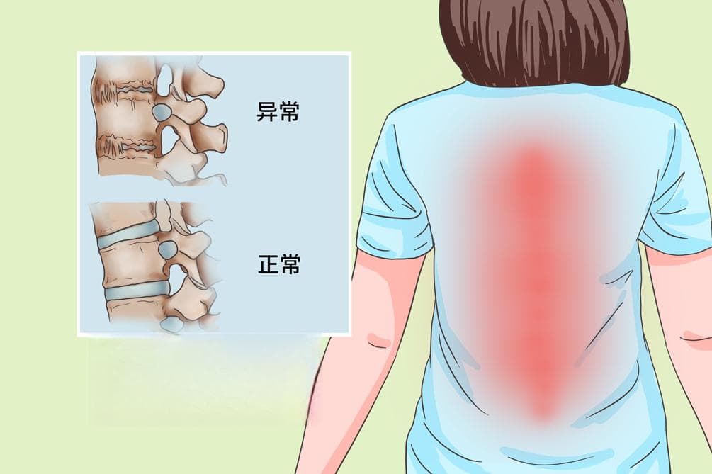 强直性脊柱炎最新疗法