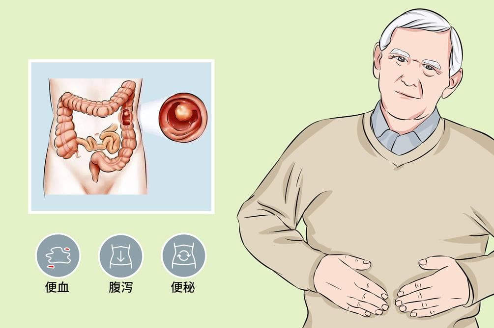 乙状结肠息肉：从病因到预防的全面解析