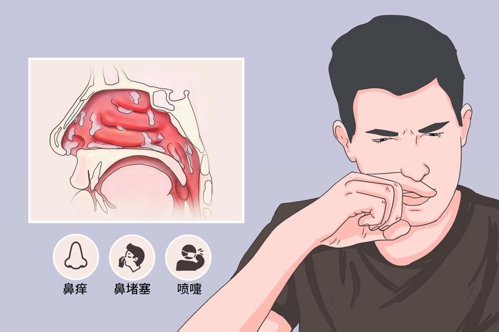 过敏性鼻炎过敏源一般是什么