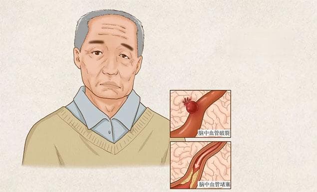男子连续加班突发脑卒中！身体出现这些信号要高度警惕→