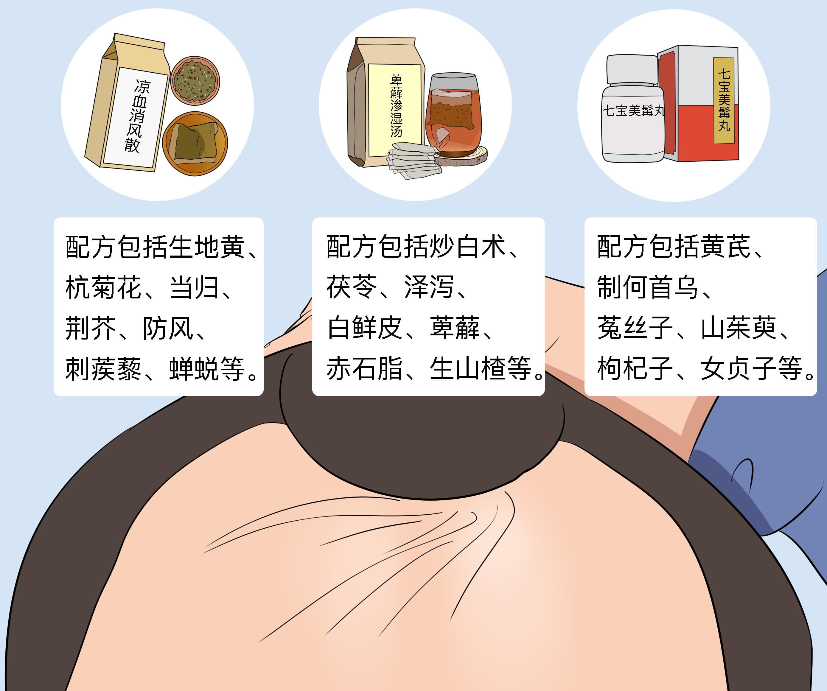 脂溢性脱发的中医辨证治疗：三种常见证型的中药配方