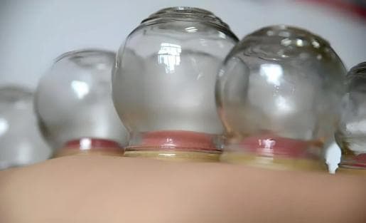 火罐拔出水泡？专家告诉你怎么回事