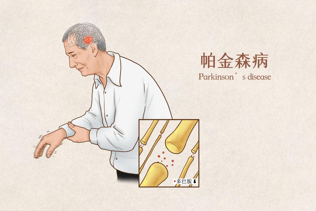 这5种走路姿势，可能是疾病征兆！