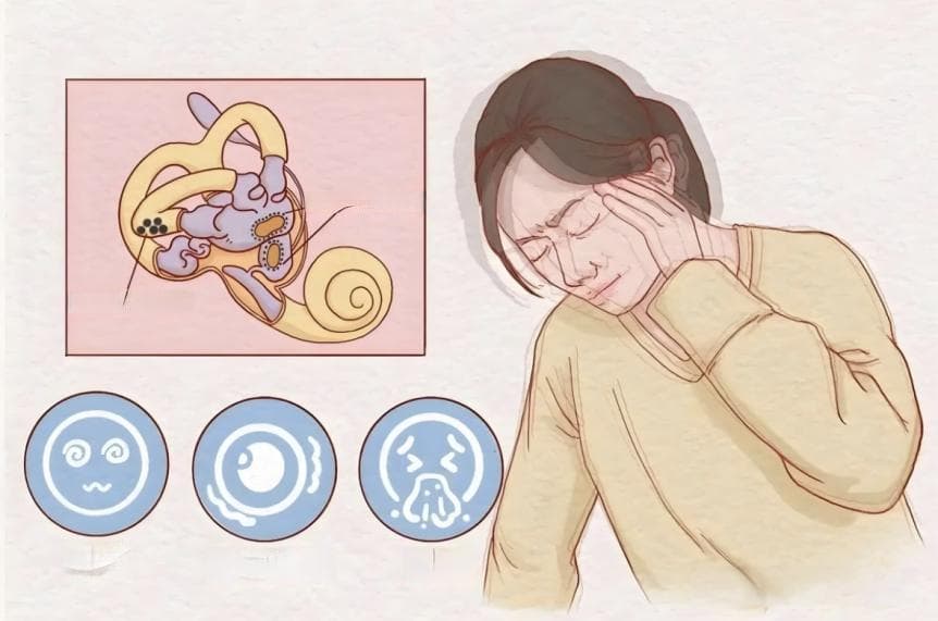 上班头晕？当心是耳石症！一文读懂症状判断与治疗要点