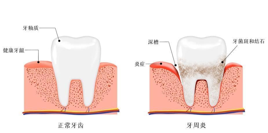 牙周炎与糖尿病的相互“纠缠”，不可忽视！