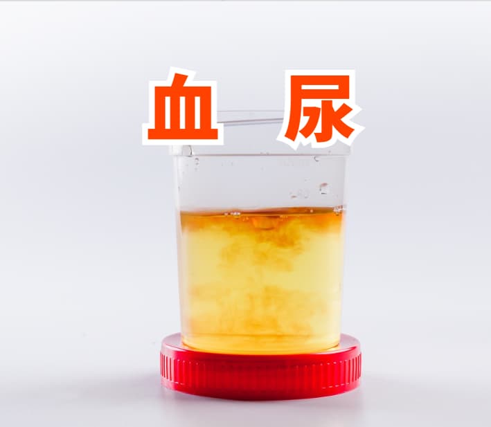 血尿是什么原因？血尿症状应对方法