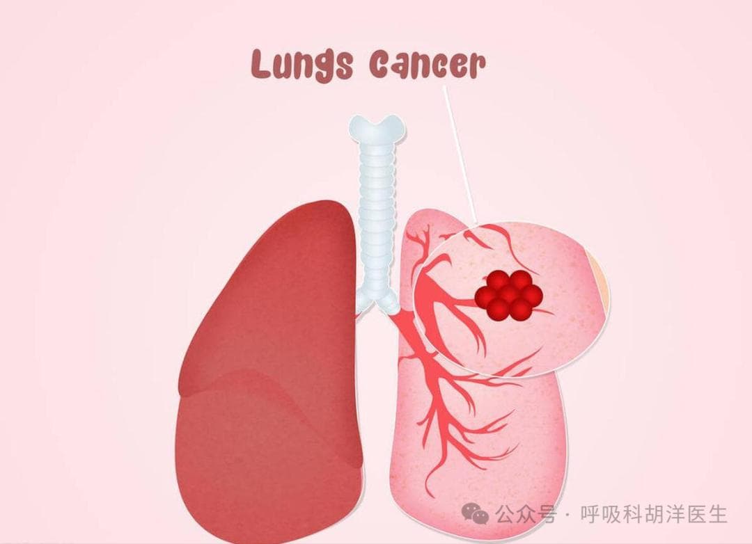肺部结节手术后，为什么有人还需要化疗吃靶向药？