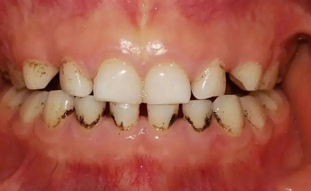 警惕儿童牙齿健康三大“敌人”：色素沉淀、脱矿、龋坏