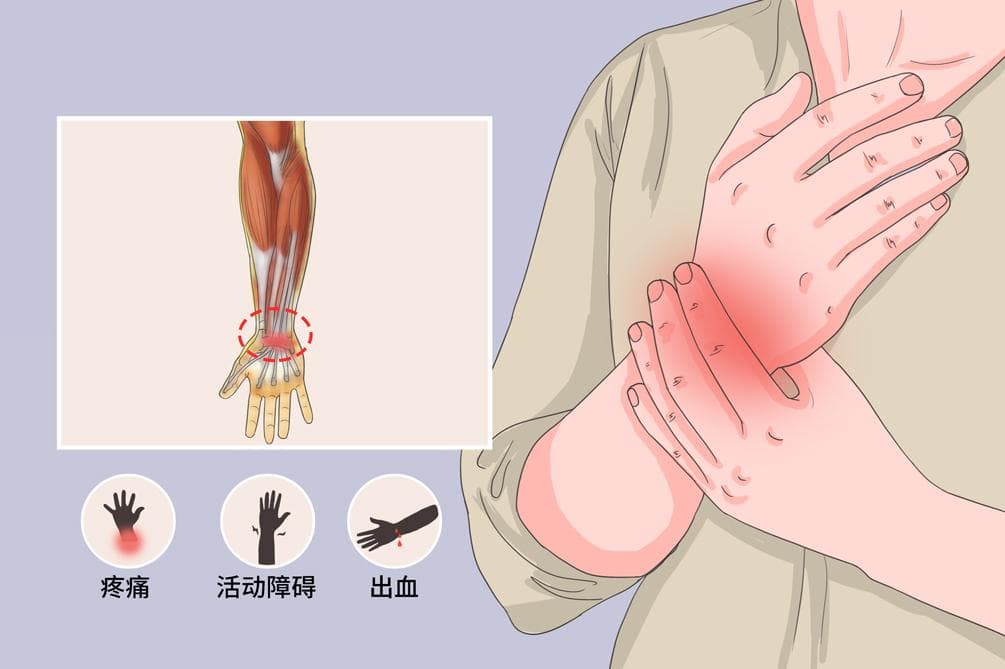 手筋断了后的科学康复训练指南