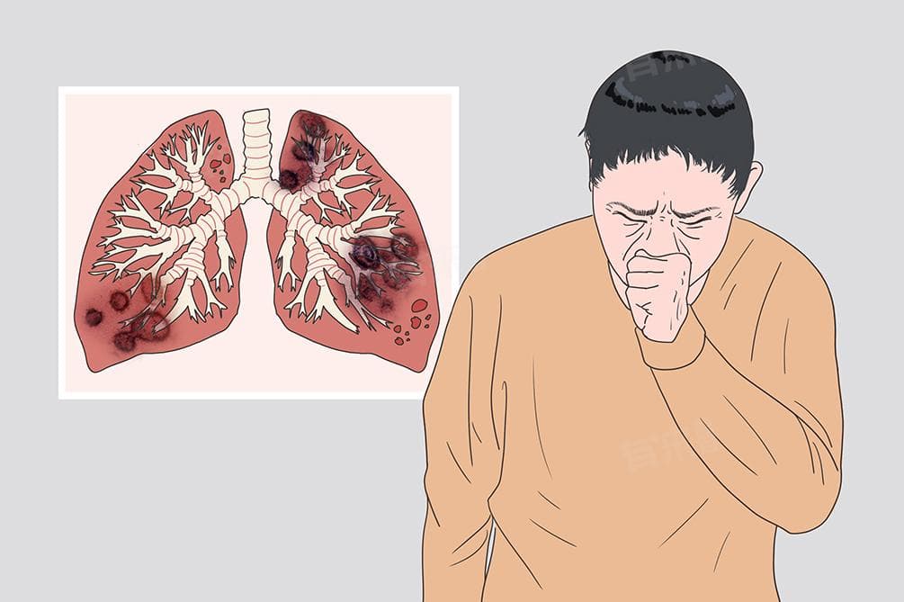 新型冠状病毒感染的症状及注意事项