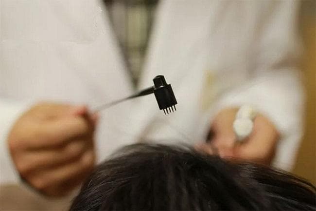 带状疱疹性神经痛，针灸治疗有妙招