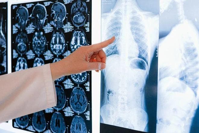 肝性脑病全面解析：成因、治疗方法与利福昔明的关键作用