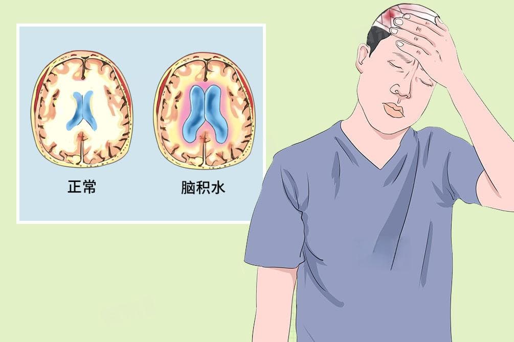 脑积水的治疗方法及注意事项