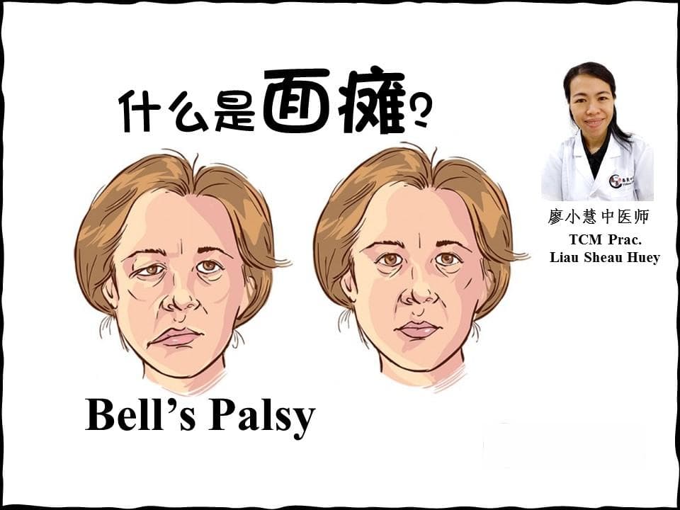 面瘫（学名：面神经麻痹）【廖小慧医师】