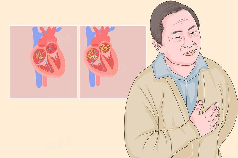 心脏房颤的最佳治疗方法