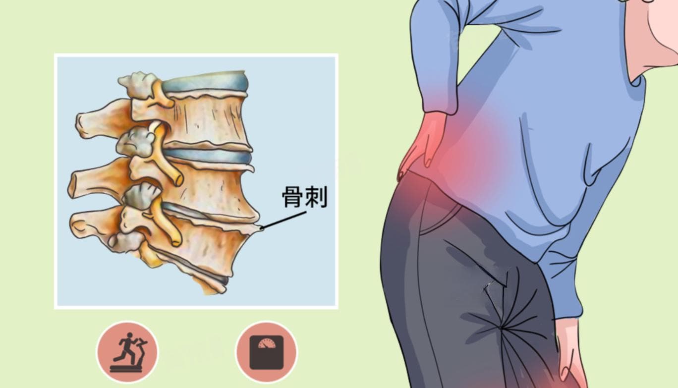 骨刺四大疗法详解：如何选择最适合的治疗方案
