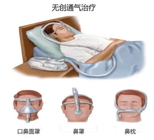 有肺大泡能否用呼吸机？如何与制氧机相配合？5个关键细节让呼吸机更有效！