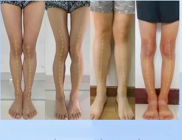 关注青少年腿型健康：不良腿形对青少年身体的影响及矫正方法