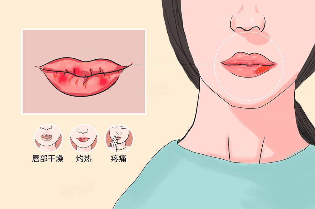 唇炎怎么自己治疗