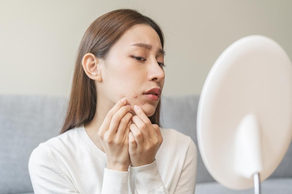 又长痘痘了？从痘痘位置找出原因与改善方法