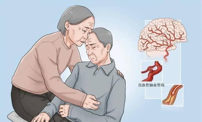 脑卒中重在预防，快速识别降低伤害