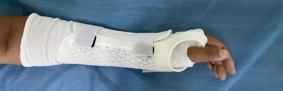 3D打印外固定支具助力腕关节骨折恢复