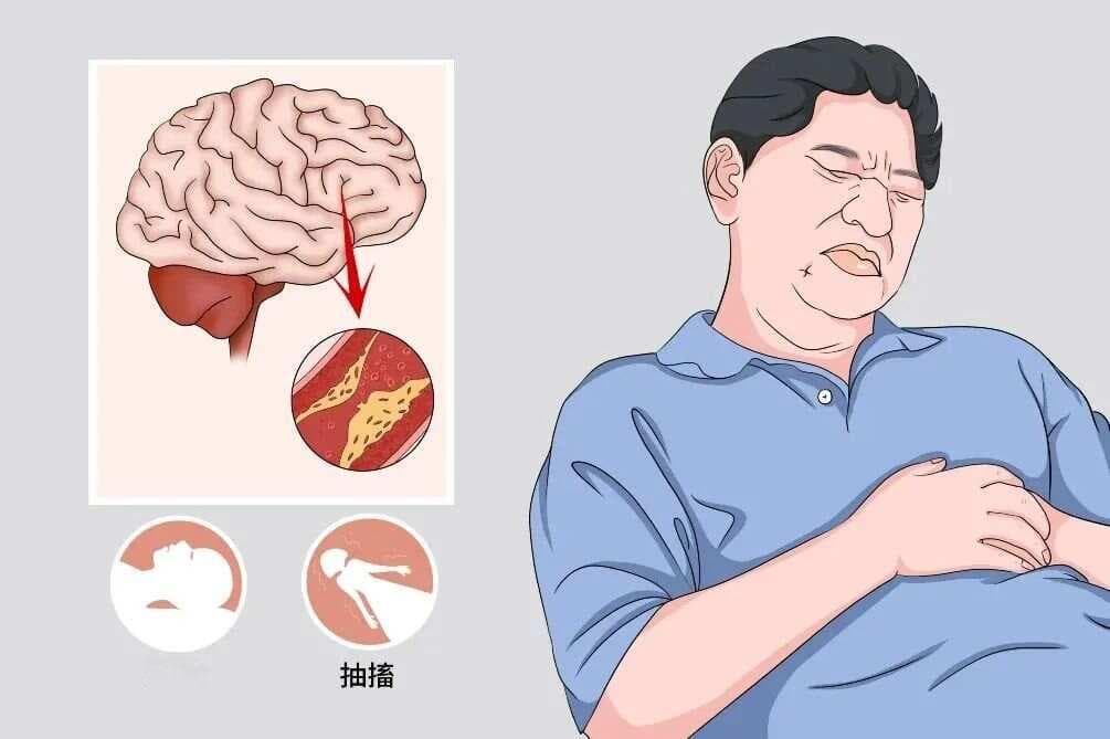阿-斯综合征的急救措施