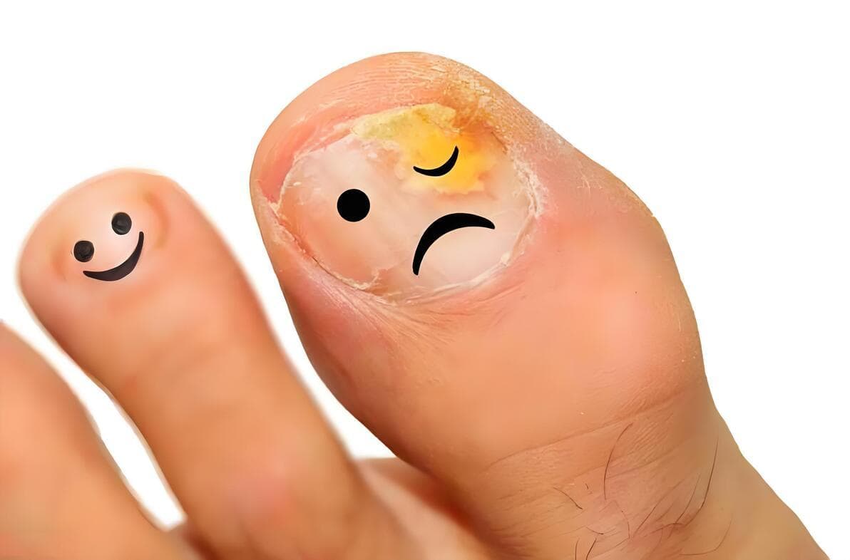灰指甲：健康与美观的双重威胁，全面预防与科学治疗至关重要