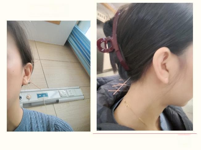 针灸显奇功，突发性耳聋患者重获"声"机