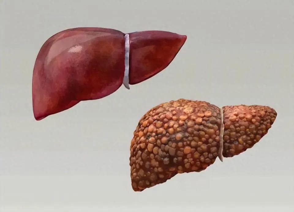 肝硬化患者日常如何护理？饮食注意什么？如何早期筛查？