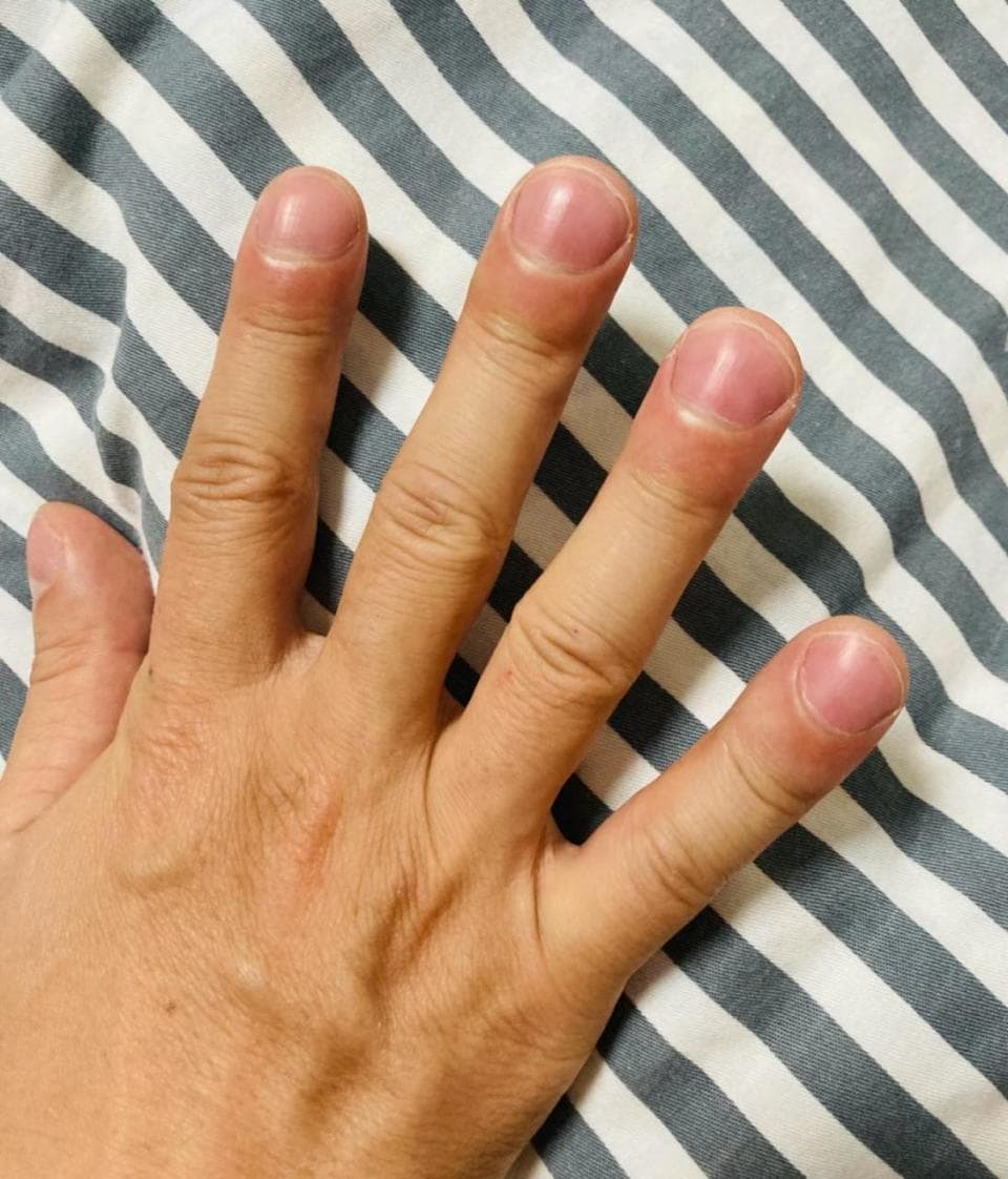 女子晒出手掌后被诊断出肝脏疾病，网络医生“立功”