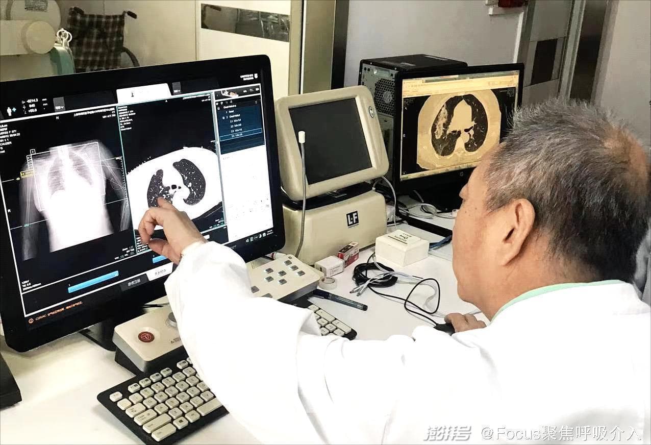肺部结节不用开刀——肺结节消融“以针代刀”