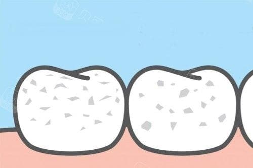 牙齿松动怎么办？牙周治疗、牙齿固定、牙齿种植等7种补救方法详解