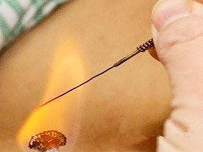 火针疗法：独具特色的中医针法