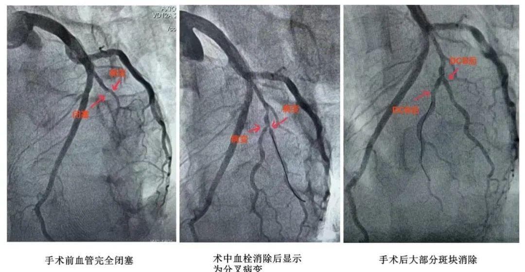 “不放支架”也能成功救治急性心梗患者？来看→