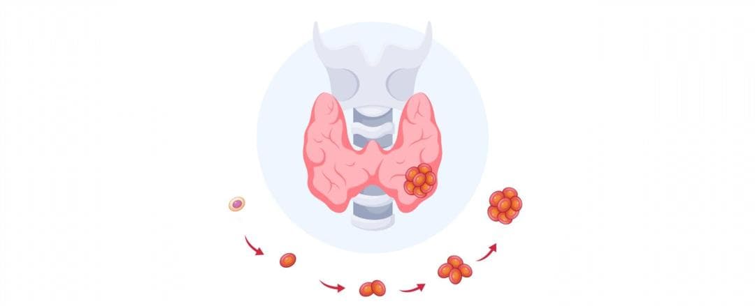 体检报告上的甲状腺结节到底要不要紧？一文说清