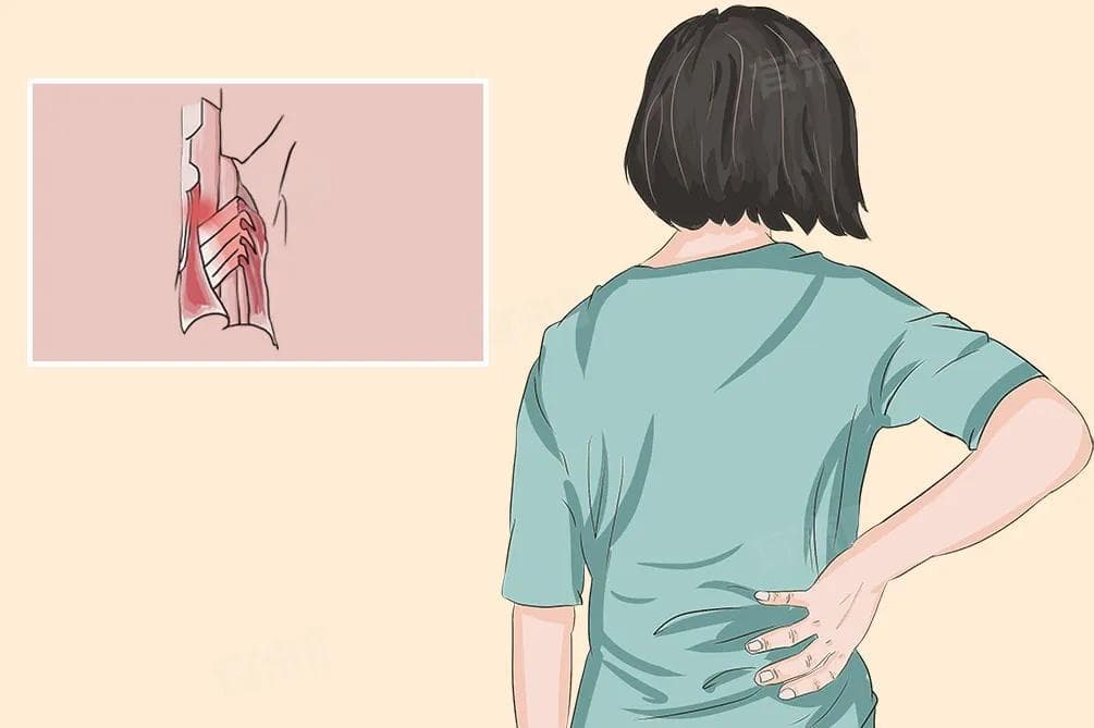 腰肌劳损最佳自愈方法