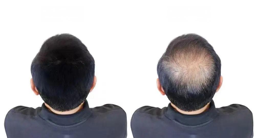 头发掉得厉害？有一种情况不及时处理，小心永久性脱发