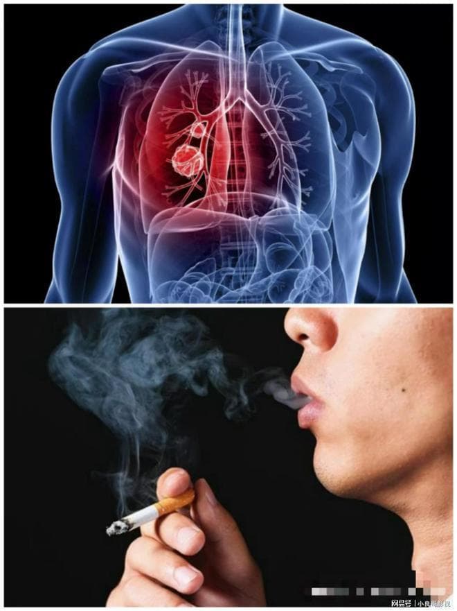 心理护理：为肺癌患者的心灵护航