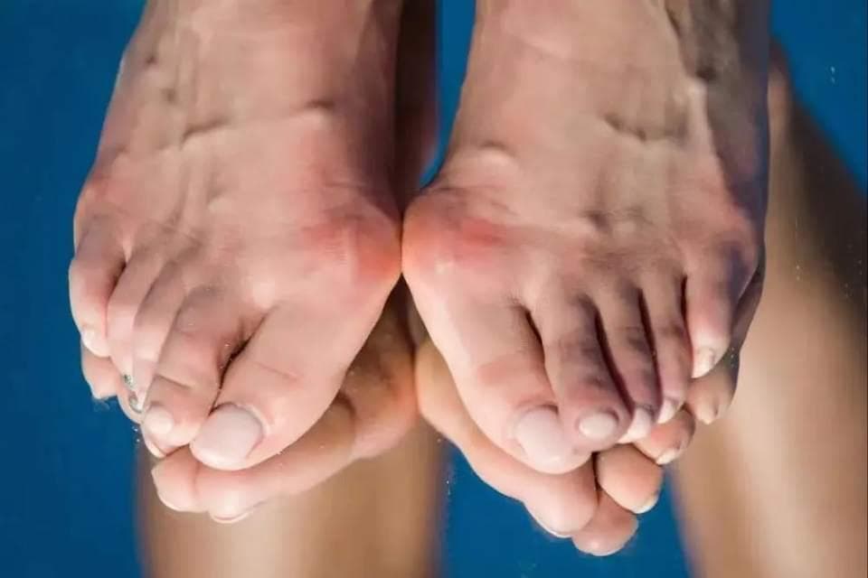 走路脚痛，是拇外翻？不用手术也能治好？7个患者常见问题